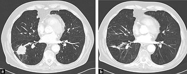 Before & After of Lung SABR