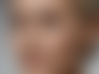 Lifting de supercílios: uma técnica para rejuvenescimento do terço superior da face