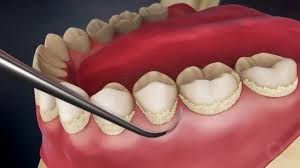 What causes tartar on teeth and how to prevent it