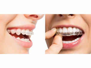 Do clear aligners work? When are they indicated and what are their limitations?