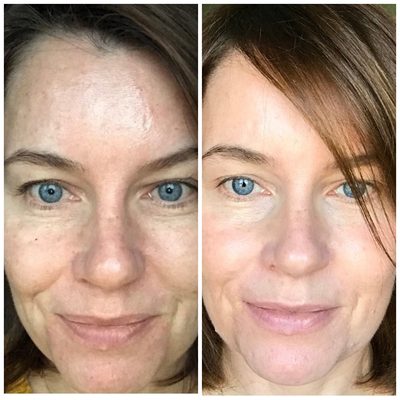 Skin Boosters bodytlc