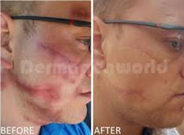 dermapen2.jpeg