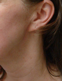 after-AcuBeauty-treatment-small.jpg