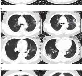 Características clínicas de pacientes infectados com o novo coronavírus de 2019 em Wuhan, China