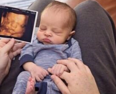 3D ultrasound