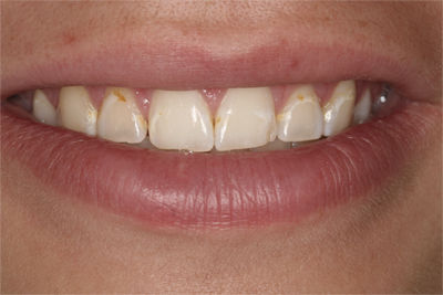 Patient 2 Before