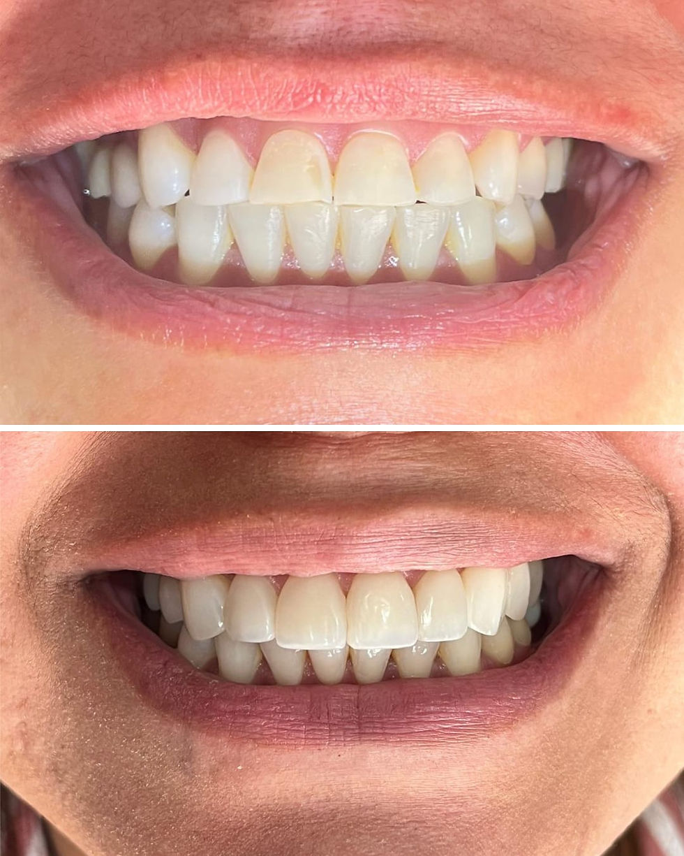 sorriso natural, antes e depois de facetas em resinda