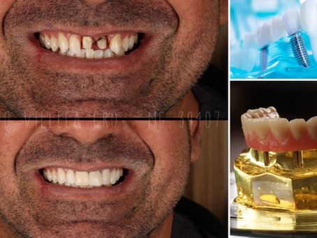 Quais são os tipos de implantes dentários e qual é o ideal para você?