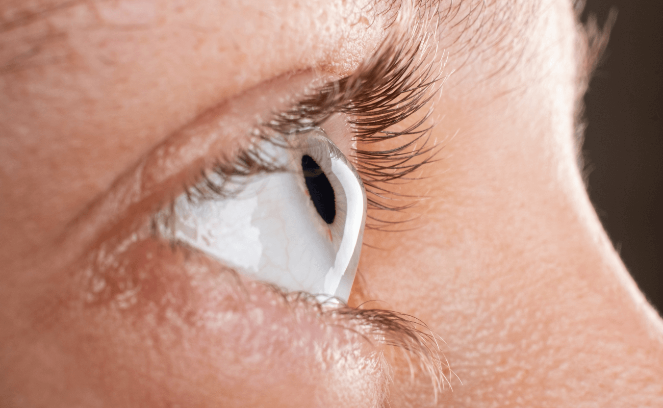 Navigating Keratoconus Treatment in Dallas, TX