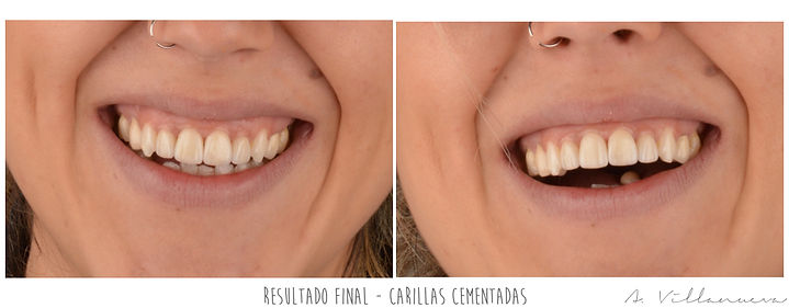 zaragoza-dentista-implantes-carillas-estetica-dental-andres-villanueva-iberdent-clinica-endodoncia-microscopica-aragon-implantes-dentales-implantologia-oral-blanqueamiento-corona-empaste-villanuevadental-odontologo