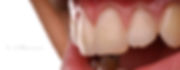 zaragoza-dentista-implantes-carillas-estetica-dental-andres-villanueva-iberdent-clinica-endodoncia-microscopica-aragon-implantes-dentales-implantologia-oral-blanqueamiento-corona-empaste-villanuevadental-odontologo