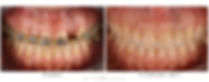 zaragoza-dentista-implantes-carillas-estetica-dental-andres-villanueva-iberdent-clinica-endodoncia-microscopica-aragon-implantes-dentales-implantologia-oral-blanqueamiento-corona-empaste-villanuevadental-odontologo