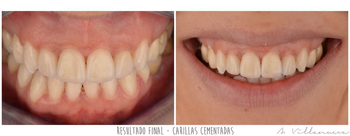 zaragoza-dentista-implantes-carillas-estetica-dental-andres-villanueva-iberdent-clinica-endodoncia-microscopica-aragon-implantes-dentales-implantologia-oral-blanqueamiento-corona-empaste-villanuevadental-odontologo