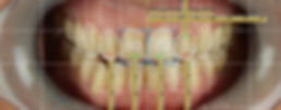 zaragoza-dentista-implantes-carillas-estetica-dental-andres-villanueva-iberdent-clinica-endodoncia-microscopica-aragon-implantes-dentales-implantologia-oral-blanqueamiento-corona-empaste-villanuevadental-odontologo