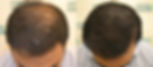 DHI Hair Restoration Result 1