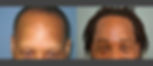 DHI Eyebrow Restoration Before & After