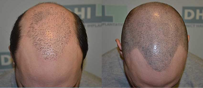 DHI Hair Restoration Result 2