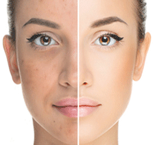 Skin Rejuvenation IPL