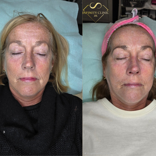 BioRePeel Belfast Before & After: Real Client Results at Infinity Clinic