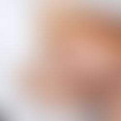What Is Microdermabrasion? Benefits, Results & Why Clients Love It