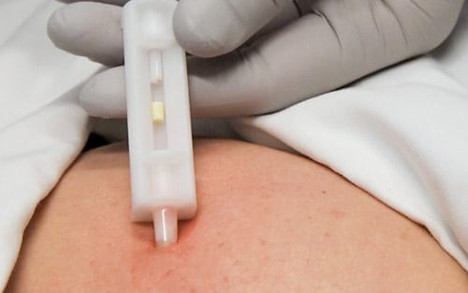 hormone pellet therapy royal kartier beauty spa