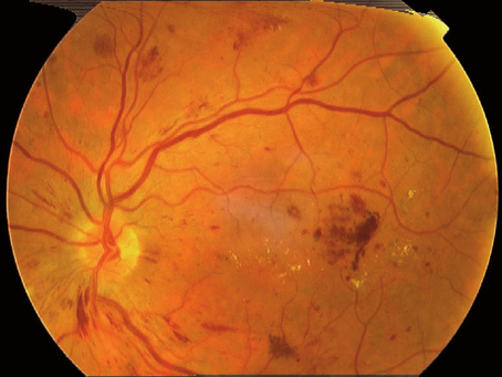 Retinopatia Diabética