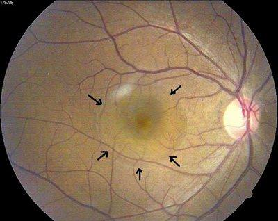 Coriorretinopatia Serosa Central