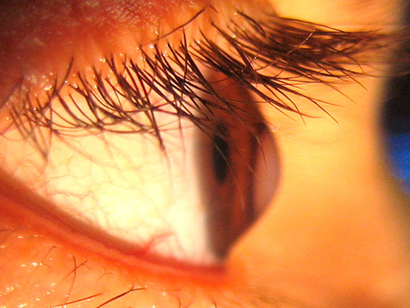 Ceratocone