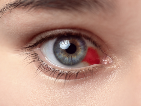 Hemorragia Subconjuntival
