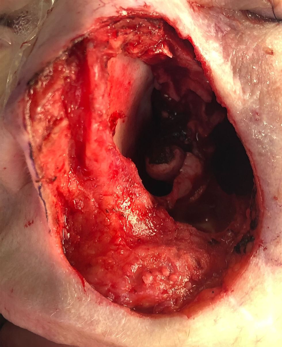 Large facial defect resulting from excision of cheek skin and maxilla