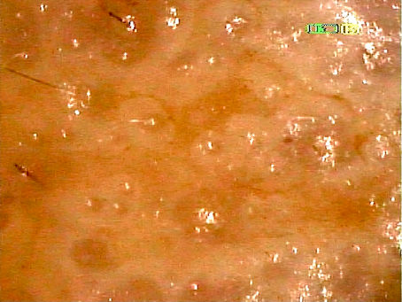 炎症後にできるシミ(PIH)　その３