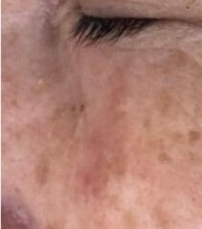  炎症性色素沈着(PIH)　その１