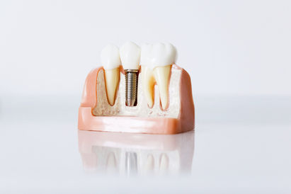 Root Canal