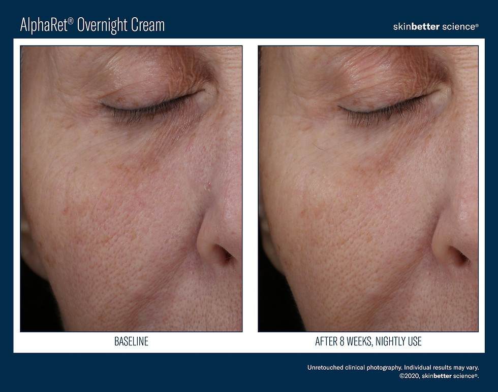 Thumbnail: SkinBetter AlphaRet® Overnight Cream - the perfect retinol to help reduce lines and wrinkles 