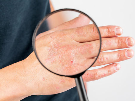 Todo lo que necesitas saber sobre Dermatitis Atópica