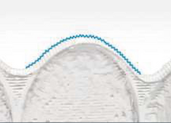 Dental Aligners