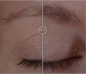 Before and after eye treatment