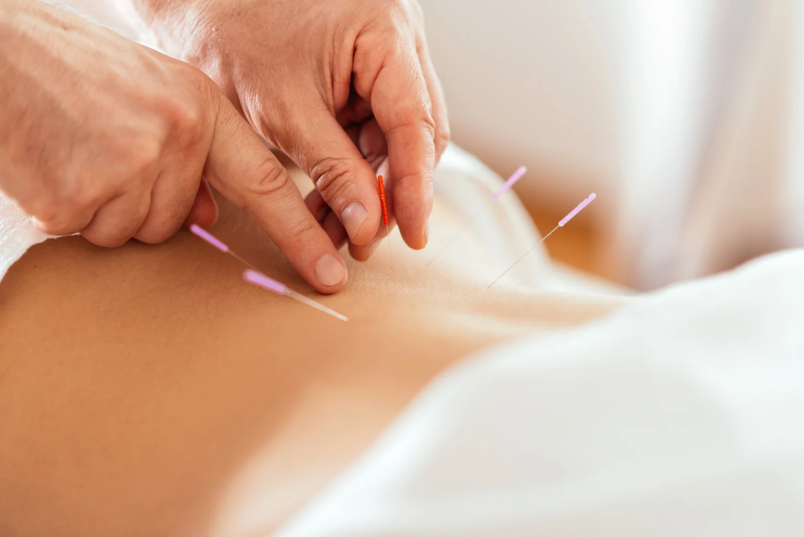 Acupuncture