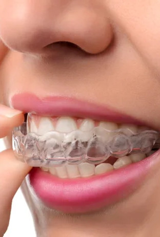 Invisalign teeth straightening Biggleswade, Bedfordshire