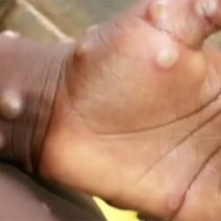 Se confirma primer caso de viruela símica en Hidalgo