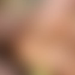 Se confirma primer caso de viruela símica en Hidalgo