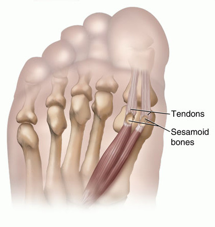 Sesamoiditis