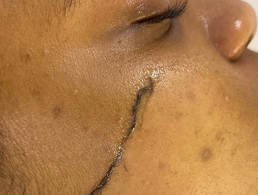 Dead skin and Peach Fuzz is being removed and exfoliated