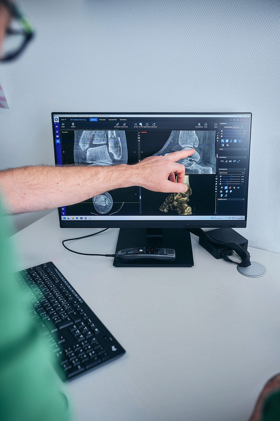 Alt-Text:

"Arzt zeigt auf DVT-Aufnahme eines Sprunggelenks am Bildschirm der Befundungssoftware