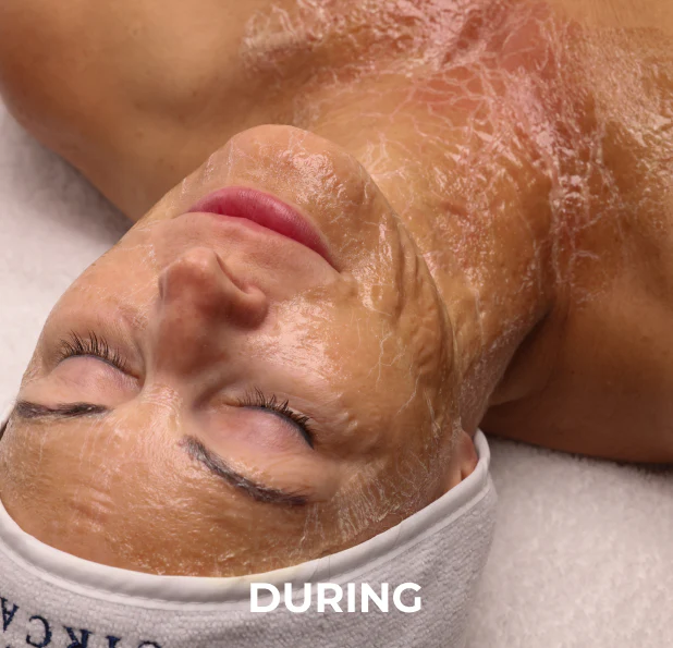 Woman's face and neck with skin peeling, text DURING.