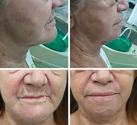 Overdenture