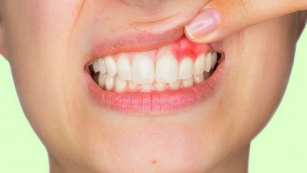 Gengiva Sangrando Ao Passar Fio Dental Porque minha gengiva sangra?