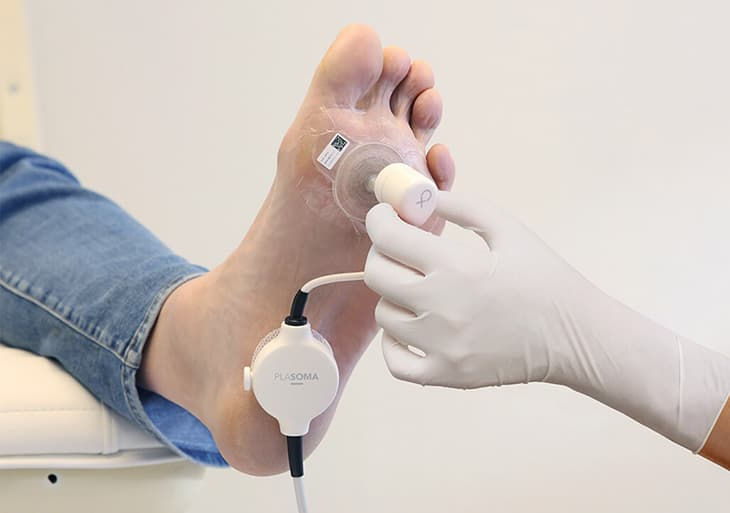 Plasmacure’s PLASOMA cold plasma wound care system in use: a non-invasive, CE-marked device designed to accelerate healing in diabetic foot ulcers and chronic wounds by reducing bacterial biofilm and promoting tissue regeneration.