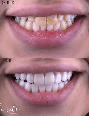 تجميل الاسنان بواسطة عدسات الاسنان 