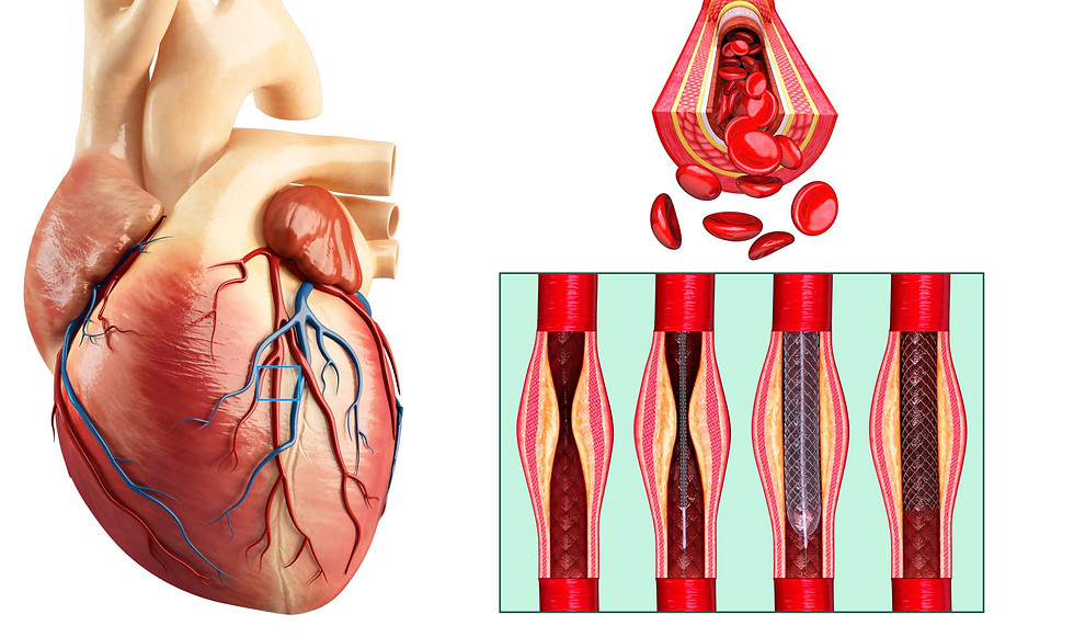 coronary-angioplasty-stent-insertion-illustration.jpg